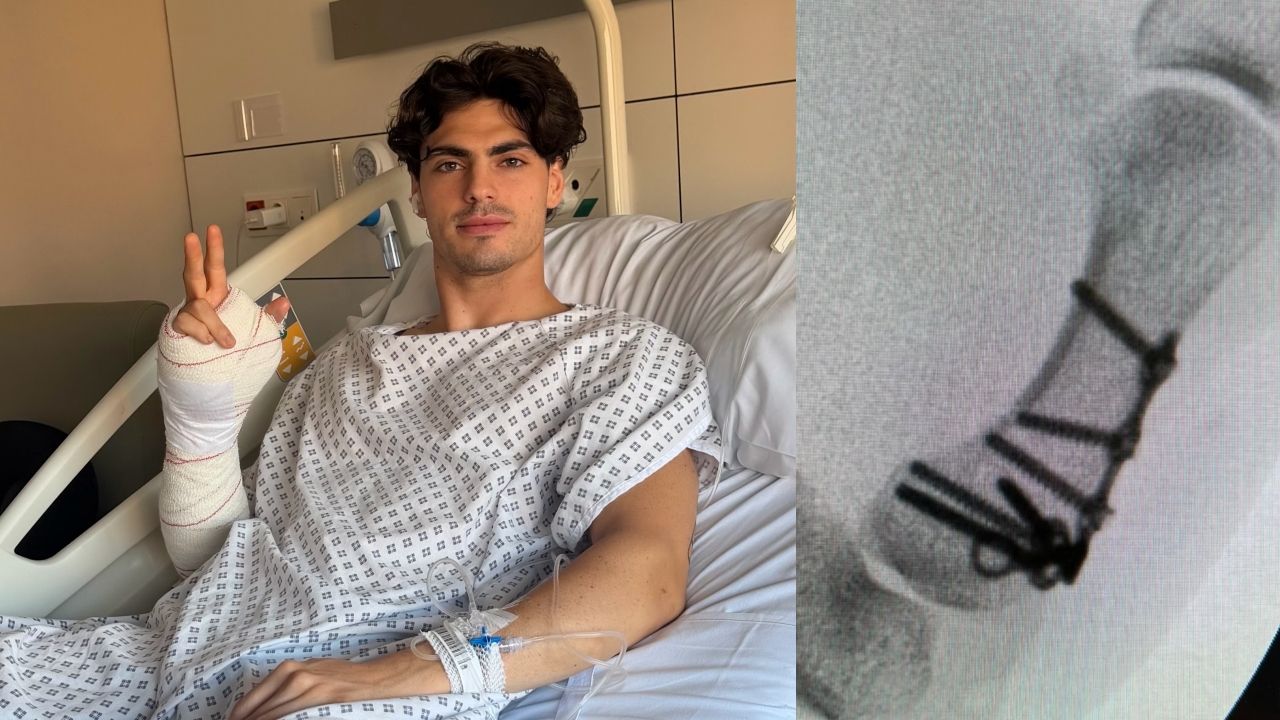 Fermín Aldeguer ha sido operado de una fractura en la base del primer hueso metacarpiano de su mano derecha